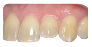 Prothèse sur implant
