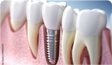 Journée découverte des spécificités de l’implant transmuqueux