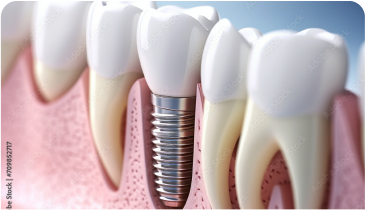 Journée découverte des spécificités de l’implant transmuqueux