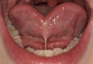 Les freinectomies linguale et labiales chez l’enfant