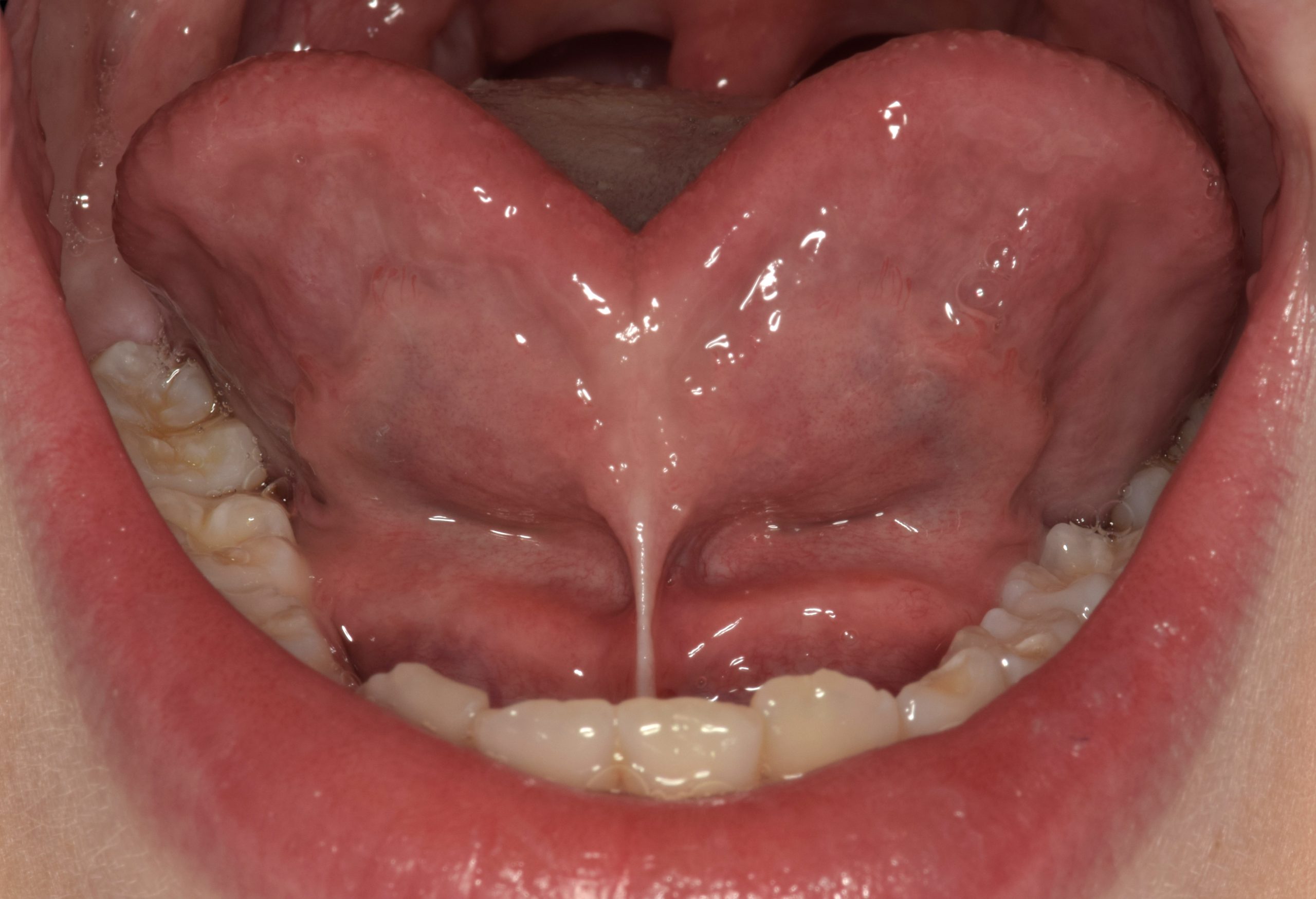 Les freinectomies linguale et labiales chez l’enfant