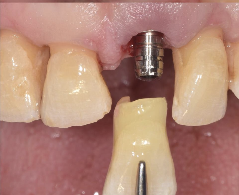 Extraction-implantation immédiate, comblement espace peri-implantaire, couronne extraite utilisée en temporisation immédiate